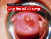Tiền ung thư cổ tử cung: Nguyên nhân nào gây ra?